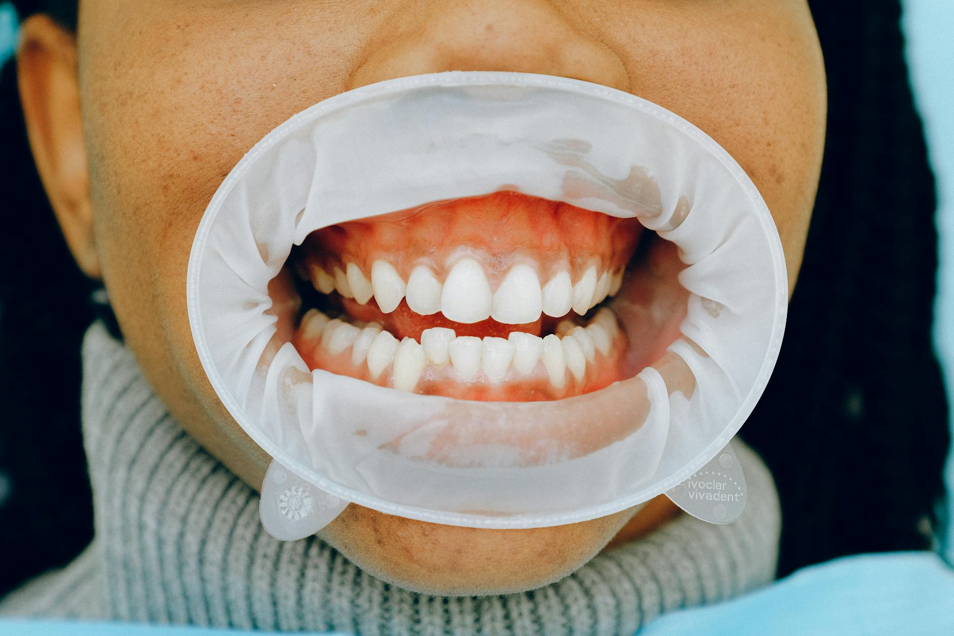 Dental exam showing gum recession and exposed teeth